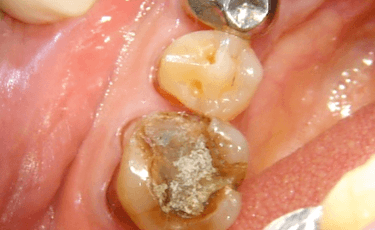 一般歯科（むし歯）1
