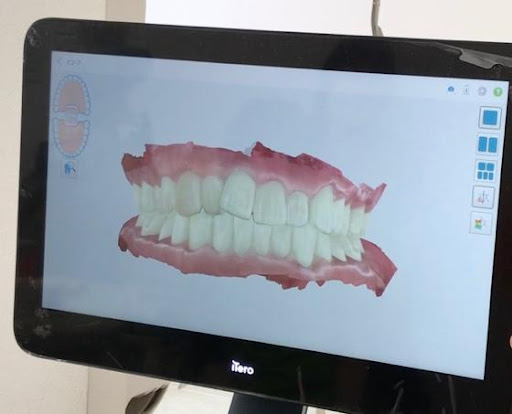 姫路市　歯医者　よねやま歯科医院　口腔内スキャナーで撮影した歯列の写真