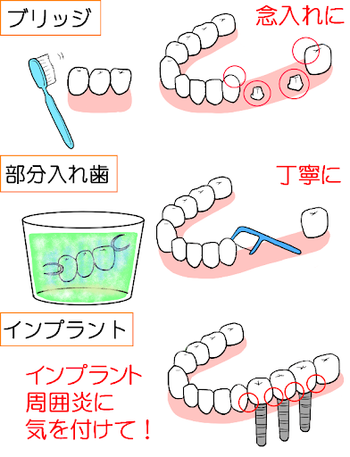 Illustrations about care for bridges, dentures and implants
