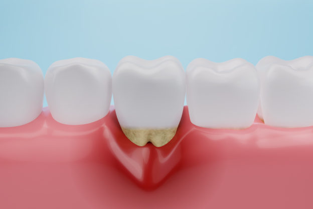 Gum disease, Gingival Recession or inflammation for dental clini